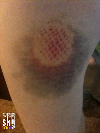 Ice Hurt, McLean County Missfits